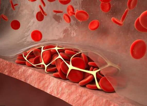 体内有血栓，身体往往有5个标志，占得越多，血管堵得越多